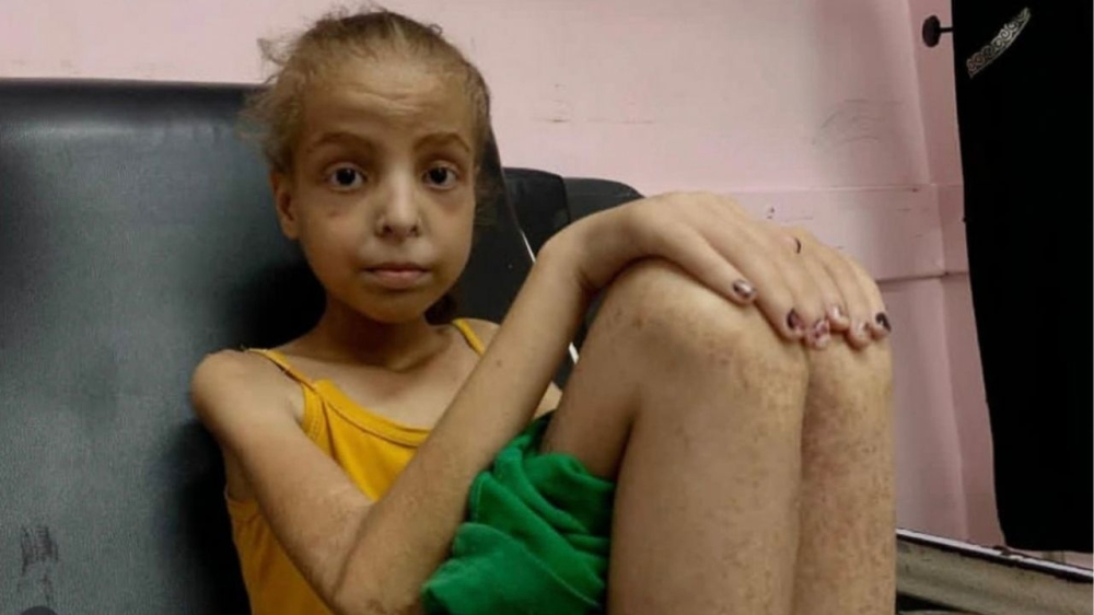 One Gaza girl’s fight to survive extreme hunger