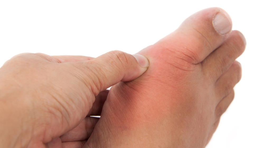 What is gout, and why is it on the rise? What is gout, and why is it on the rise?